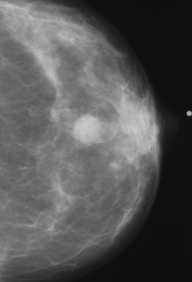Abnormal mammogram.
