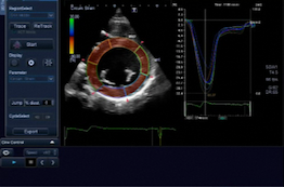 Echocardiographic Evaluation of Cancer Patients