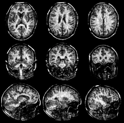 Improved MRI scans of the myelin sheaths in the brain should allow multiple sclerosis to be detected at an early stage.