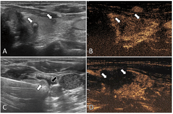 Ultrasound (US) images in a 57-year-old female patient with multifocal papillary thyroid carcinoma (PTC). 