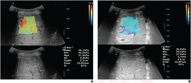 12-Year-Old Boy With Chronic Budd-Chiari Syndrome, Presenting With Recurrent Abdominal Pain and Distention, After Undergoing Left Hepatic Vein Angioplasty. 