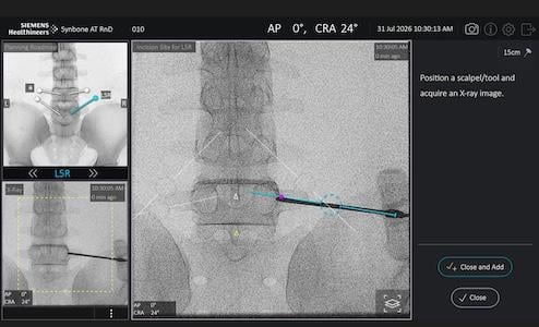 Siemens Healthineers Releases Software for Trackerless Guidance in Spinal Surgery