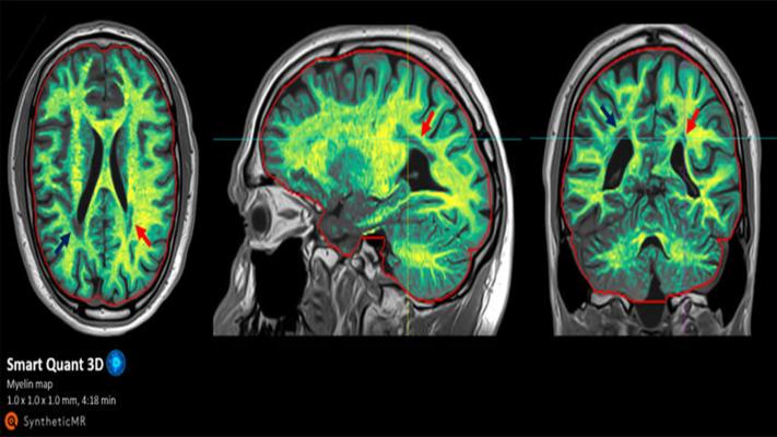 Инновационная технология Smart Quant Neuro 3D обеспечивает автоматическое измерение различных тканей головного мозга для улучшения поддержки принятия решений о заболевании головного мозга, оценки прогрессирования и мониторинга эффекта терапии.
