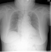Application Helps Physicians Identify More Lung Nodules in Chest X-Rays