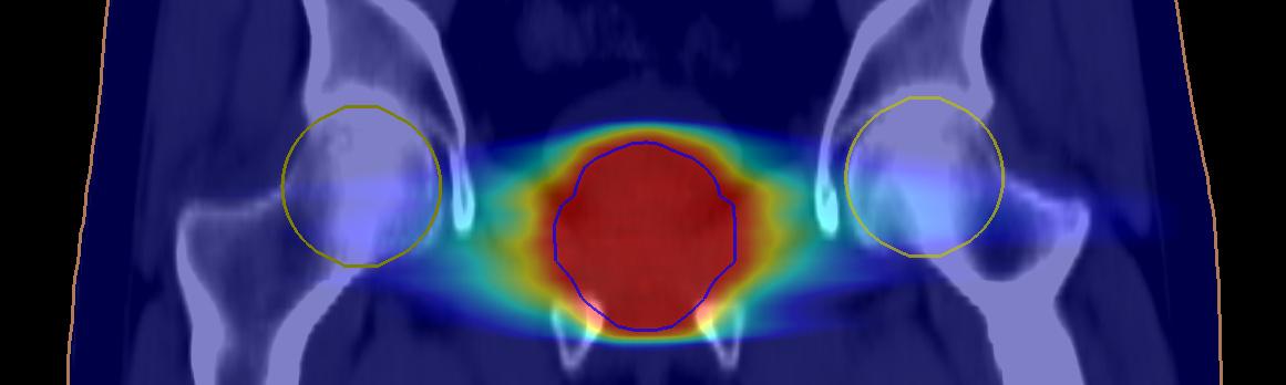 Synthetic CT Images Suitable for Prostate Cancer Radiotherapy Planning