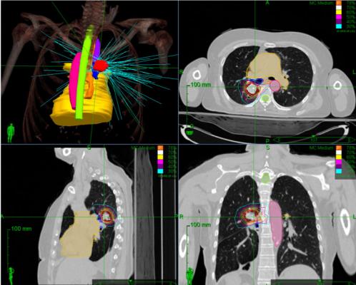 A phase 1 clinical trial led by investigators at the University of Chicago Medicine testing the effects of stereotactic body radiotherapy for treating multiple metastases has determined that treatments used for single tumors can also be safely used for treating patients with multiple metastases.