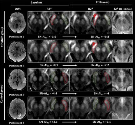 Iron Measurements With MRI Reveal Stroke's Impact on Brain