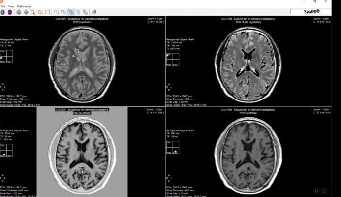 SyMRI Software Receives FDA Clearance for Use With Siemens MRI Systems