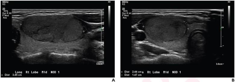 Longitudinal and transverse grayscale ultrasound images of thyroid nodule in 17-year-old patient with benign follicular adenoma, based on surgical excision alone. Overall impression for all three radiologists was benign (true negative). ACR TI-RADS recommendation for all three radiologists was FNA (false positive). Deep learning algorithm recommendation was FNA (false positive). 