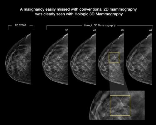 An example of breast tomosynthesis 3-D mammography detection of lesion.