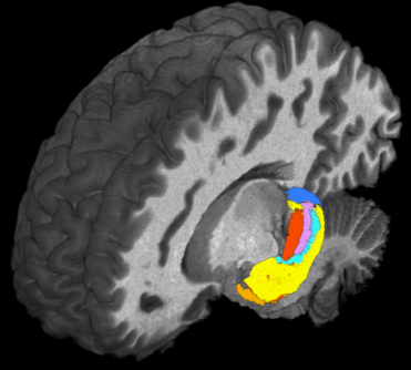 Using ultra-high field magnetic resonance imaging (MRI) to map the brains of people with #Down_syndrome (#DS), #researchers from #CaseWesternReserveUniversity, #ClevelandClinic, University Hospitals and other institutions detected subtle differences in the structure and function of the #hippocampus—a region of the #brain tied to memory and learning.
