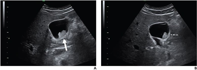 Transverse (A) and sagittal (B) greyscale ultrasound images of gallbladder show 25-mm nonmobile sessile polyp with adjacent wall thickening (arrow, A; calipers, B). Polyp was classified as extremely low risk by no readers, low risk by 4 readers, and indeterminate risk by 6 readers. Surgical consultation was recommended by all 10 readers. Pathologic assessment from cholecystectomy yielded adenoma, consistent with benign neoplastic polyp.