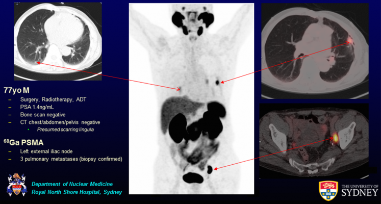 A 77-year-old male with recurrent lymph node and pulmonary metastases detected by Ga-68 PSMA PET/CT but not by conventional imaging