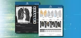 LungPrint Discovery offers fully automatic radiological metrics and unique, time-saving airway visualizations
