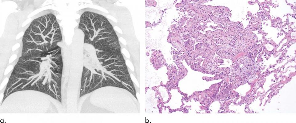 Pulmonary imaging is important in the diagnosis of the acute lung injury associated with vaping, known as electronic cigarette or vaping product use-associated lung injury (EVALI), according to a special review article published in the journal Radiology