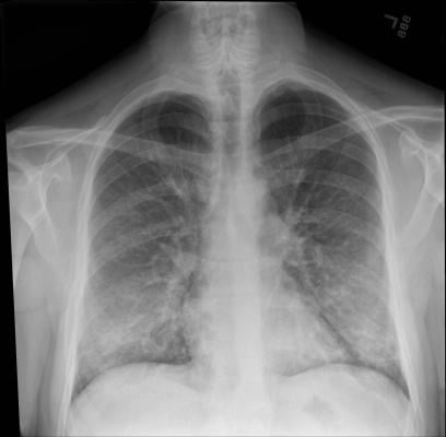 This chest X-ray of a patient being treated for e-cigarette or vaping-associated lung injury shows lung opacities, densities and whitish cloud-like areas which are typically seen with unusual pneumonias, fluid in lungs or lung inflammation. Image courtesy of Intermountain Healthcare