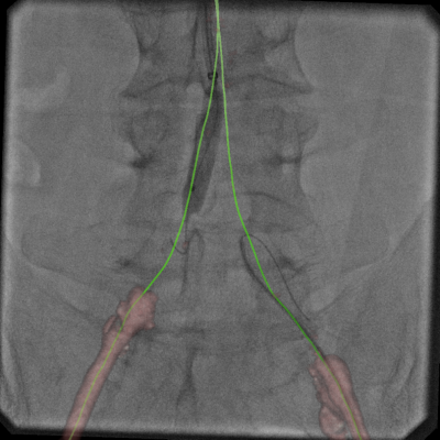 An example of Vessel Assist used to create vessel centerlines through a CTO to help guide revascularization in the cath lab.