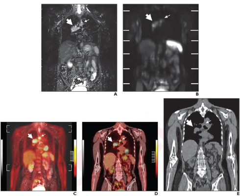Per reference-standard diagnosis, TNM stage was IIIA (T3N2M0) and Veterans Administration Lung Cancer Study Group stage was LS. Coronal (A) STIR image and (B) DWI from whole-body MRI.
