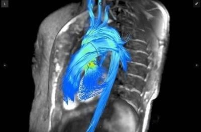 Arterys, 4-D Flow software, cardiac MRI, RSNA 2016