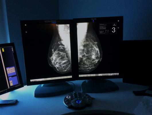 breast cancer, stage I-III, irradiation, regional nodes, EORTC, Philip Poortmans