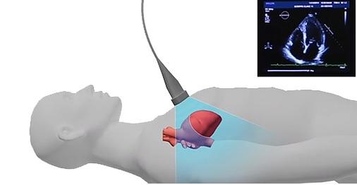 CDN to Integrate Advanced Cardiac Imaging Tools From DiA Imaging Analysis