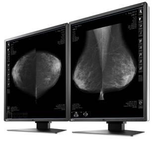 TMIST, lead-in study, tomosynthesis, mammography, The Ottawa Hospital Breast Health Centre, Canada