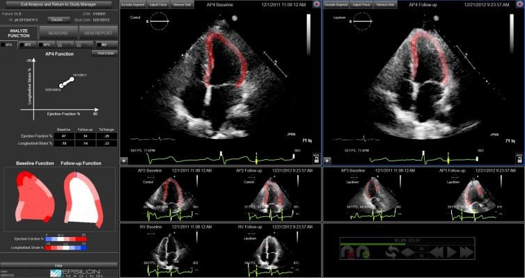 Strain Imaging Improves Cardiac Surveillance of Certain Breast