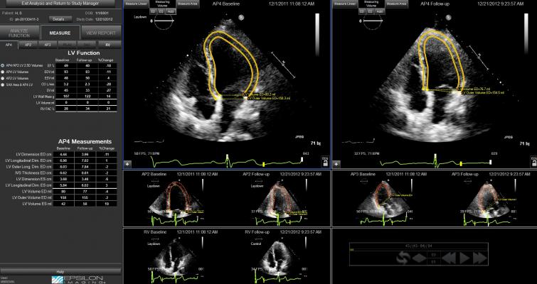 Epsilon Imaging, EchoInsight, left ventricle, LV measurement, strain imaging, ASE 2016