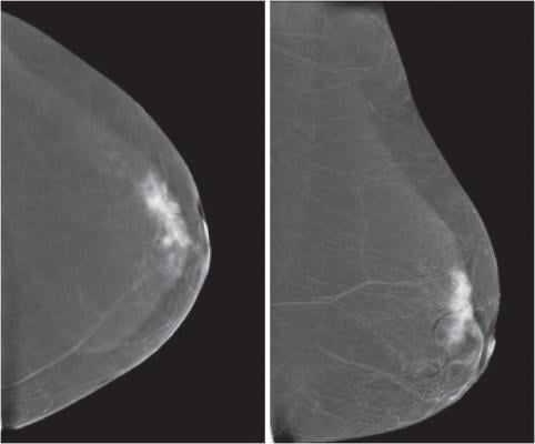 Medicaid expansion, breast cancer screening, low-income women, study, RSNA 2015