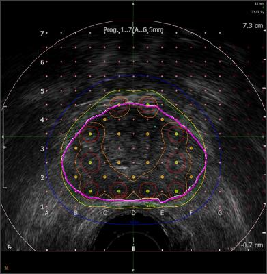 MIM Software, BK Ultrasound, bkFusion, MRI Fusion Biopsy System, prostate cancer, RSNA 2016