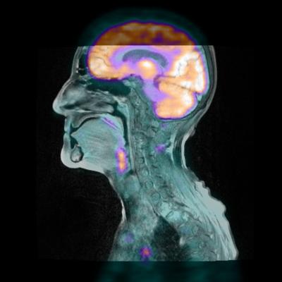 Mirada Medical PET/MRI Software is Highlighted in Multiple Research Studies