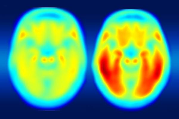 tau protein, Alzheimer's, PET scan, imaging agent, brain decline, Washington University in St. Louis