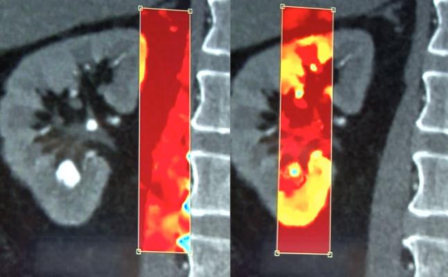 Spectral CT of kidney stones