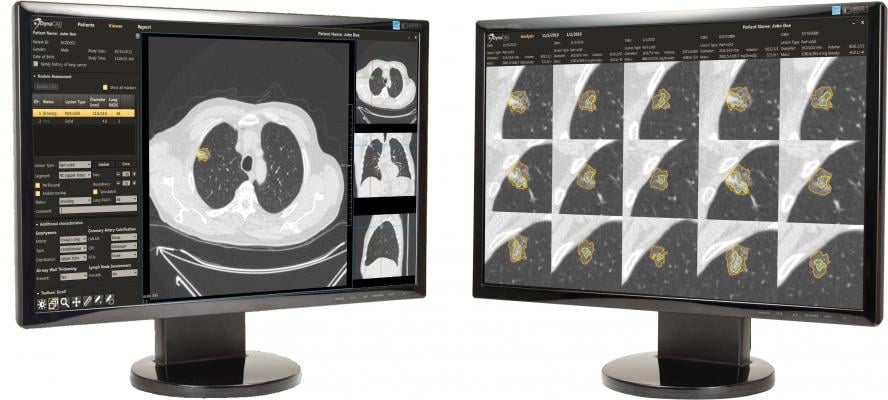lung cancer screening, computed tomography, CT, screening criteria, PLOS Medicine study