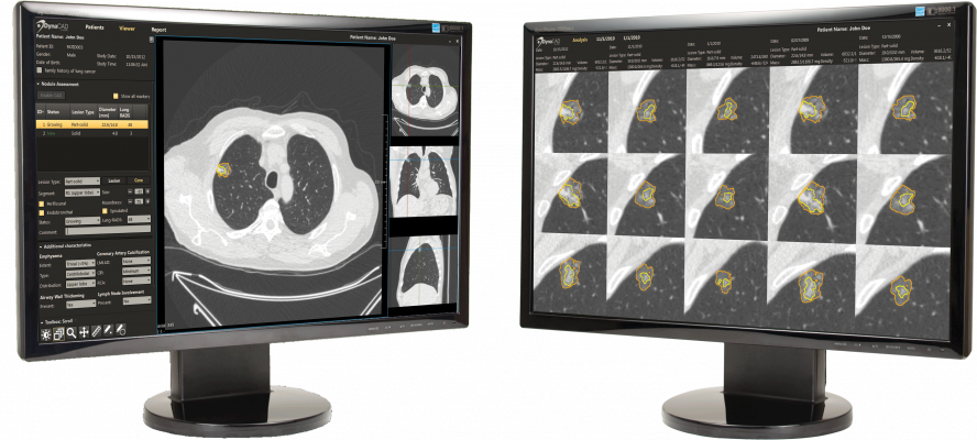  Philips_Lung cancer DualScreens