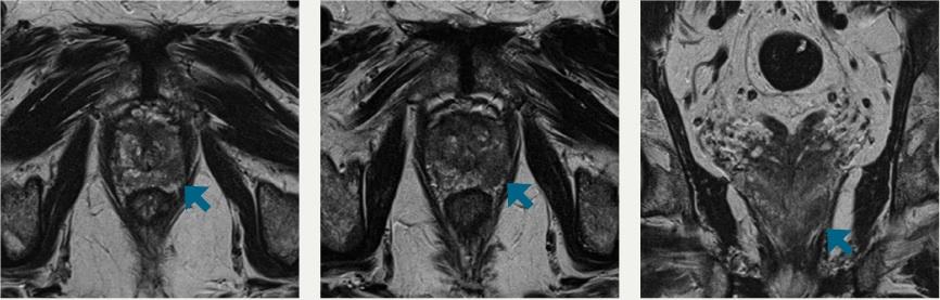 MRI, prostate cancer, zinc, UT Southwestern Medical Center study
