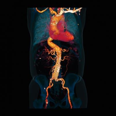 Orange County, Calif. Hospital Adopts Siemens Somatom Force CT for Cardiac Imaging