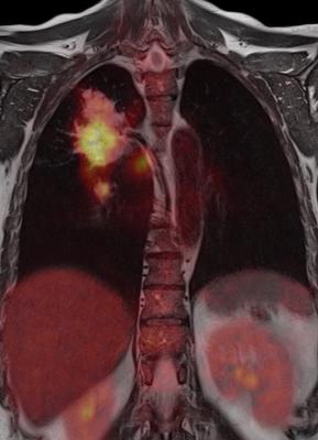 Imaging agent helps predict success of lung cancer therapy