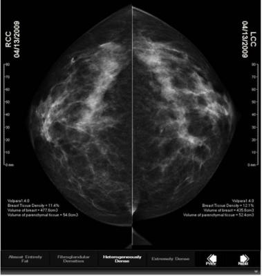 VolparaDensity, 3.1, tomosynthesis, mammography