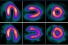 UltraSPECT, 10th anniversary, WBR technology, Wide Beam Reconstruction, FDA approval, nuclear imaging