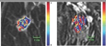 breast MRI, ER-positive breast cancer detection, Case Western Reserve study