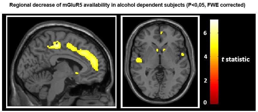 PET-CT study, alcoholic brain, SNMMI 2016, mGluR5 receptor