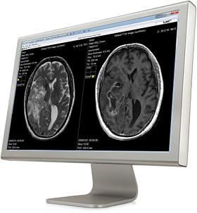 SyMRI, MD Anderson Cancer Center, brain tumor characterization