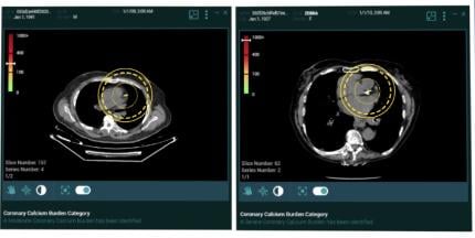 Zebra Medical Vision now offers artificial intelligence (A) medical imaging analytics for its cardiac solution HealthCCSng, which enables the quantification of the coronary artery calcium (CAC) on CT scans as an incidental finding. 