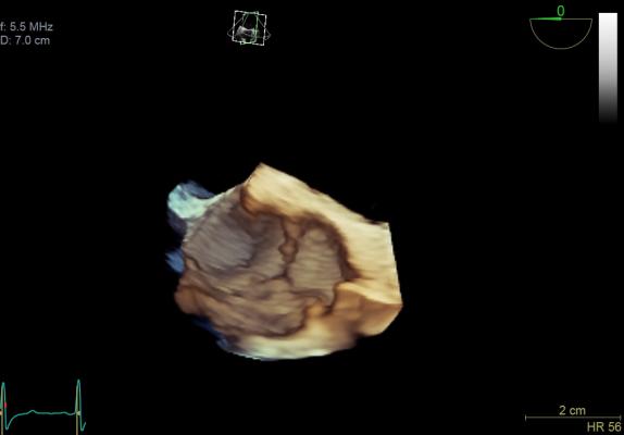 ASE 2016, Mayo Clinic study, echocardiography, aortic flow rate, patient risk stratification