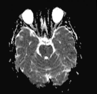 New Study Uses MRI to Probe Psychopathic Brains