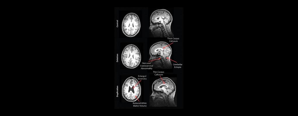 MRI Reveals Striking Brain Differences in People with Genetic Autism