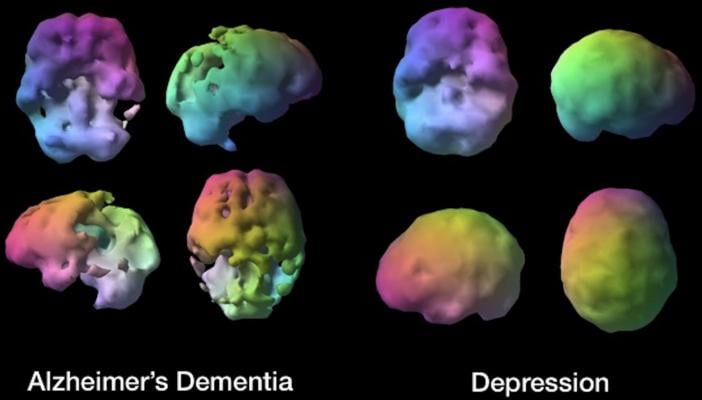 brain SPECT imaging, dementia, depression, Daniel G. Amen
