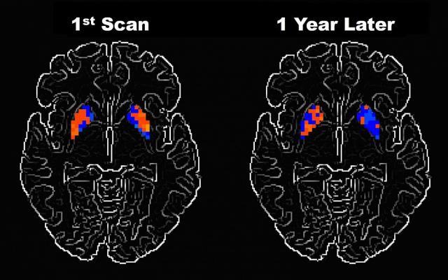 Researchers Examine How Parkinson's Disease Alters Brain ...