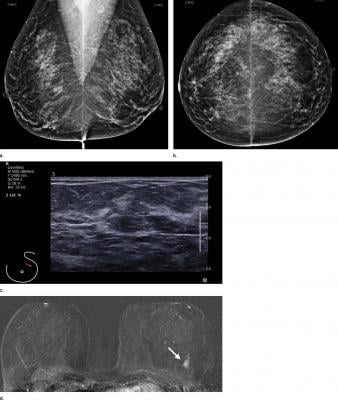 Radiology journal, breast MRI screening, average risk women, breast cancer
